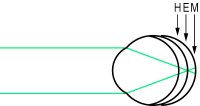 Fig. A8 Emmetropia E, axial hyperopia H and axial myopia M. In emmetropia, parallel rays are focused on the retina. In hyperopia, the eye is relatively too short and the principal focus is behind the retina