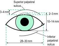 palpebral slant