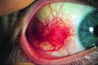 Steroid eye drops for episcleritis