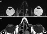 Fig. M3 MRI scans of the normal eyes of the same individual. A, a T2-weighted scan designed to show high contrast between the fluid filled eyes and the surrounding tissues. B, a T1-weighted scan showing more tissue differentiation and darker fluid filled eyes and the surrounding tissues. B, a T1-weighted scan showing more tissue differentiation and darker fluid filled eyes (Courtesy of Prof