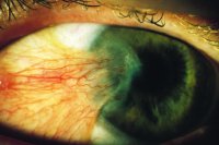Fig. P21 Advanced case of pterygium