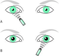 bilateral pupil constriction barbiturates