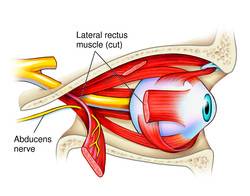 benign recurrent  cranial nerve vi diseases  lateral rectus palsy