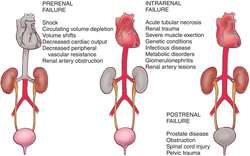 renal failure acute causes definition