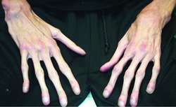 Arachnodactyly | definition of arachnodactyly by Medical dictionary