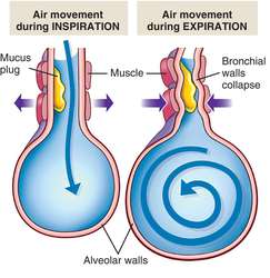 distinction walking pneumonia bronchitis