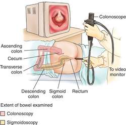 What is a colonoscopy?