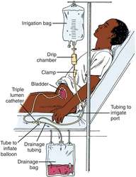 Continuous bladder irrigation | definition of continuous bladder