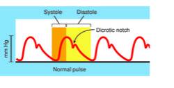 Dicrotic notch
