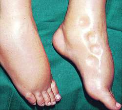 Steroid dependent dermatitis