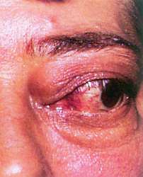 Steroid eye drops for scleritis