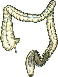 fecal impaction overflow diarrhea