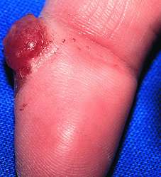 Hemangioma | definition of hemangioma by Medical dictionary