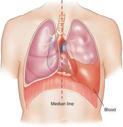 hemothorax medical definition