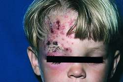Long-Term Doxycycline