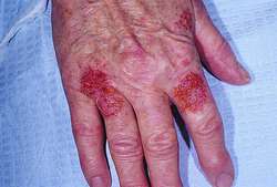 impetigo definition