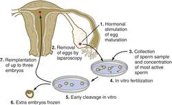 How does in vitro fertilization work?