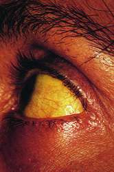 scleral icterus