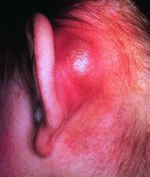 5 Causes of Skin Rash Behind The Ears With Pictures ...