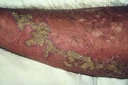 20+ Early Norwegian Scabies Pictures Background