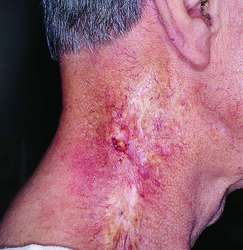 Radiation Dermatitis - Today on Medscape