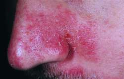 Seborrheic Dermatitis in Adults: Condition, Treatments ...