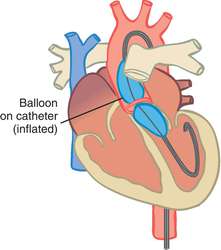 Valvuloplasty | definition of valvuloplasty by Medical dictionary