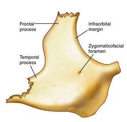 Fractured Zygomatic Bone