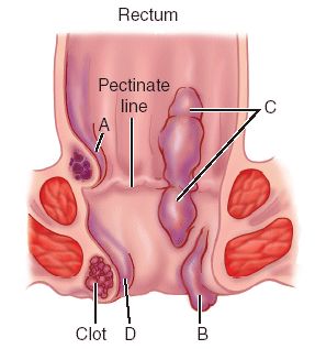 Hemorrhoid Internal