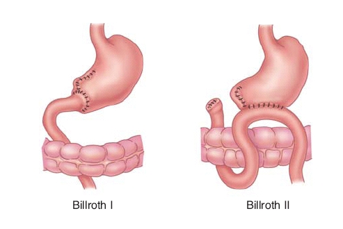 esophageal cancer fatigue