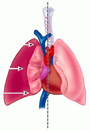 What are the symptoms of a collapsed lung?