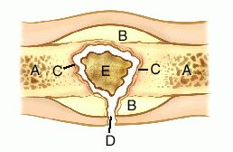 Bone Sequestra