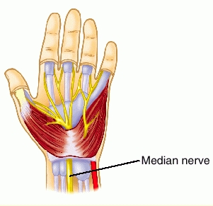 What Is Carpal Tunnel Syndrome