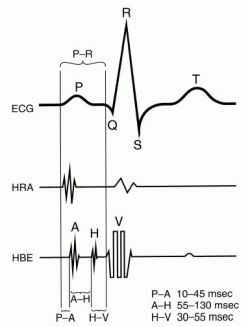 electrogram_intracardiac.jpg