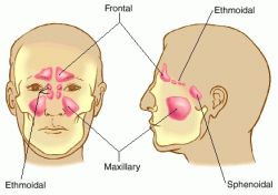 bacterial sinusitis natural remedy