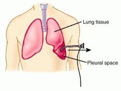 Pleural Tap