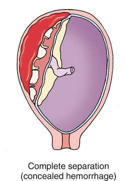 Abruptio placentae | definition of abruptio placentae by ...