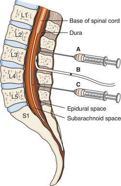 Spinal anesthesia | definition of spinal anesthesia by Medical dictionary