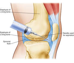 Knee steroid injection medial approach