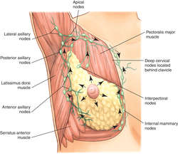 What is breast cancer with chest wall involvement?