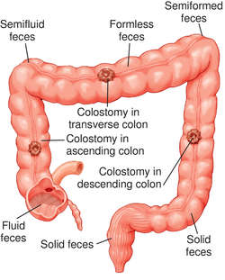 What are some differences between a colostomy and an ileostomy?