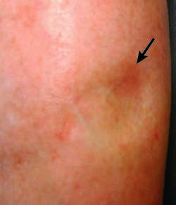 Steroid injection infection pictures