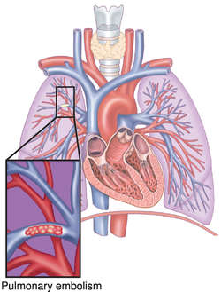 What is an embolism?