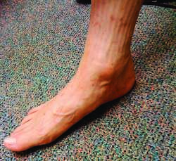 flat footed definition