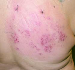 herpes simplex infections - medicinenet.com