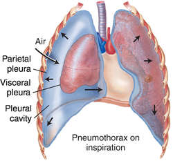 What are the symptoms of a collapsed lung?