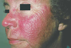 Rosacea systemic steroids