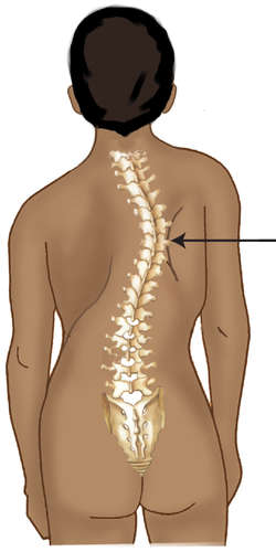 What are the treatment options for levoscoliosis?