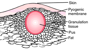 Definition Of Periodontal Abscess