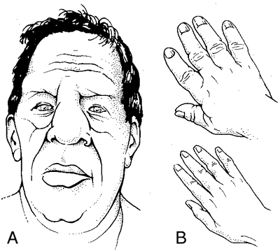 Steroids change bone structure